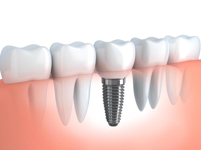 Dental Implants in Munster, IN