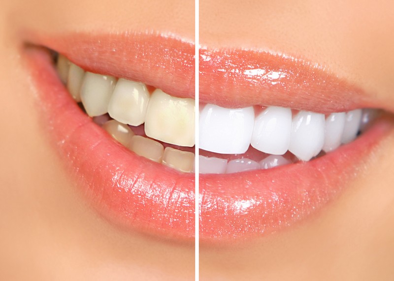 teeth whitening services in Munster, IN